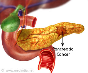 New Method That Lets an Earlier Diagnosis of Pancreatic Cancer Developed