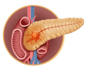 Drug Combination Shows Promise in Treating Pancreatic Tumors