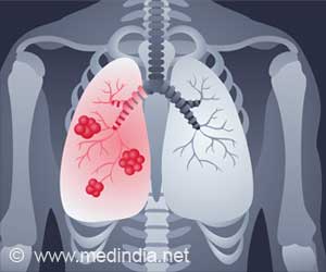 The Ongoing Concern of Missing Tuberculosis Cases in India
