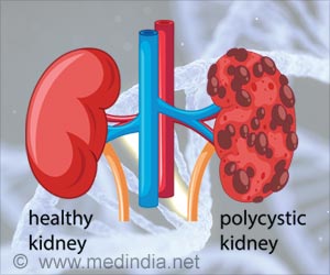 Tolvaptan Use in Autosomal Dominant Polycystic Kidney Disease