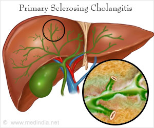  Early Syphilis May Show Signs of Acute Sclerosing Cholangitis