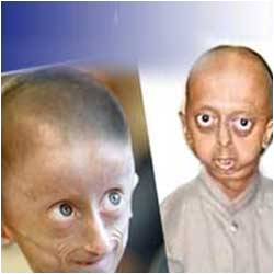 New Technology To Reverse Aging Could Help Treat Progeria