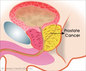 Combination Therapy Holds Promise for Advanced Prostate Cancer Treatment