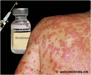 Brodalumab - A New Promising Treatment for Psoriasis