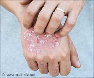Psoriasis Can Increase The Risk of Type 2 Diabetes