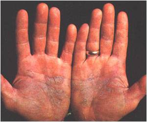  Contribution of Coding Variants to Psoriasis Much Smaller Than Assumed