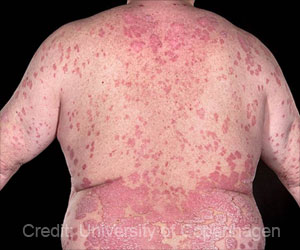 Weight Loss May Show New Hope in the Treatment of Psoriasis