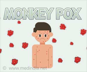Monkeypox Cases Rise to 5,189 in United States