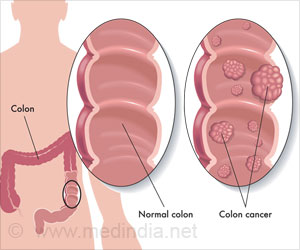  Many Takers For Colorectal Cancer Screening Kit Sent by Mail