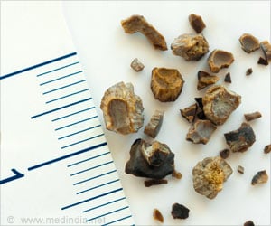 Kidney Stone Prevalence Among Adolescents On the Rise