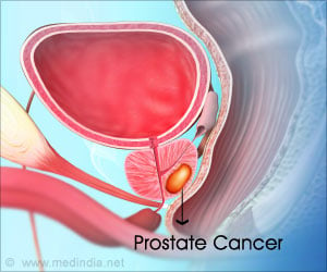 Spread of Prostate Cancer may be Delayed With Apalutamide