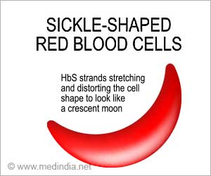 Sickle Cell Anemia's Death Toll 11 Times Higher Than Estimated