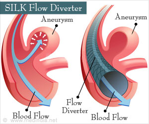 SILK Flow Diverter for Treatment of Intracranial Aneurysms