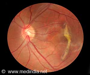  Laser Photocoagulation Helps Protect Vision from Age-Related Macular Degeneration