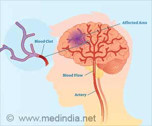 Stroke Prevented by Acute Intervention of Antiplatelet Drug Combination