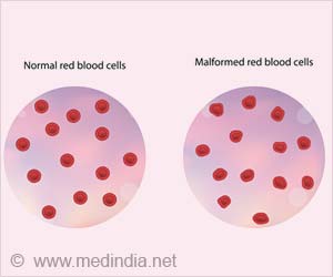 Thalassemia- A Disability That can be Treated With a Stem Cell Transplant