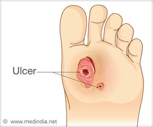 Diabetic Foot Ulcers can be Life-threatening - Interview With a Podiatrist