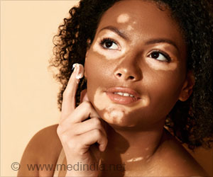 Topical Cream for Vitiligo Brings Back Normal Skin Colour