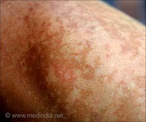 Modified Long-Lasting Immunity may Play a Role in Vitiligo