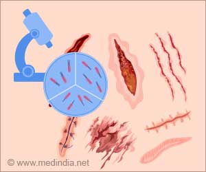 Transplanted Hair Follicles Could be the Treatment for Scars Transplanted Hair Follicles Could be the Treatment for Scars