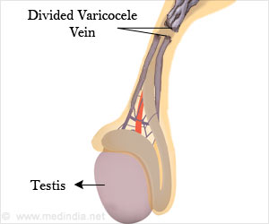 Varicocelectomy