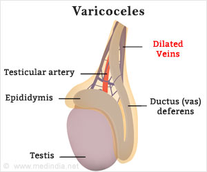  Is Varicocelectomy the Answer to Painful Varicoceles in Men?