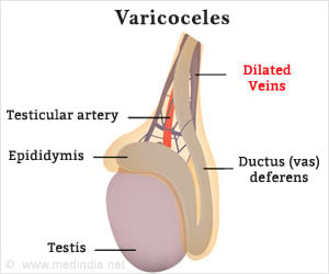 Varicocele Diet Chart