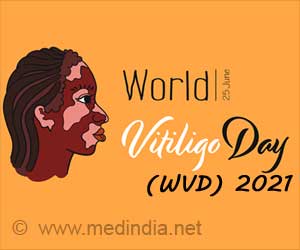 World Vitiligo Day 2021: Embracing Life With Vitiligo