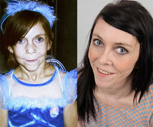 Facelift Helps Teenager With Rare Condition That Made Her Look Middle-Aged Return to Normal Life