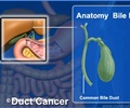 Bile Duct Cancer