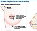 Breast Implants under Scrutiny