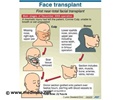 Face Transplant