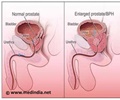 Prostate Gland Enlargement