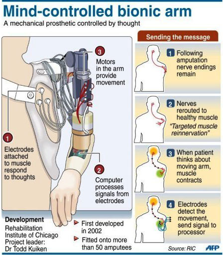 Prosthetic Limbs