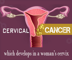 Infographics on Cervical Cancer