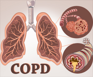 Infographics on Chronic Obstructive Pulmonary Disease