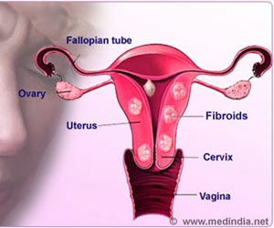 Infographics on Fibroids in Uterus Infographics on Fibroids in Uterus
