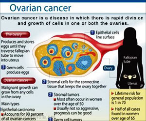 Infographics on Ovarian Cancer