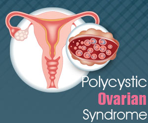 Infographics on Polycystic Ovarian Syndrome