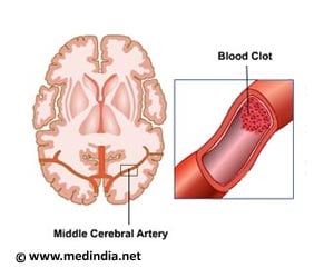 Infographics on Stroke