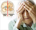Alzheimer’s disease Facts