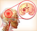 Interesting  Facts About Brain Tumors
