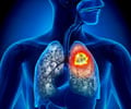 Lung Cancer - Top 10 Interesting Facts You Must Know