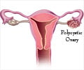 Top 15 Facts and Stats on Polycystic Ovarian Syndrome