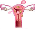 Fibroids in Uterus