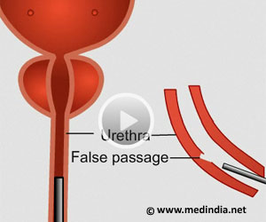 Urethral False Passage