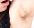 Home Remedies for Armpit Lumps Home Remedies for Armpit Lumps