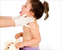 Home Remedies For Chickenpox Home Remedies For Chickenpox