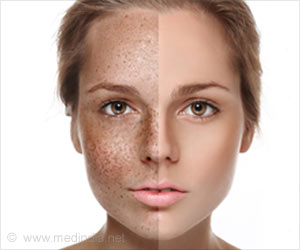 Home Remedies for Skin Pigmentation