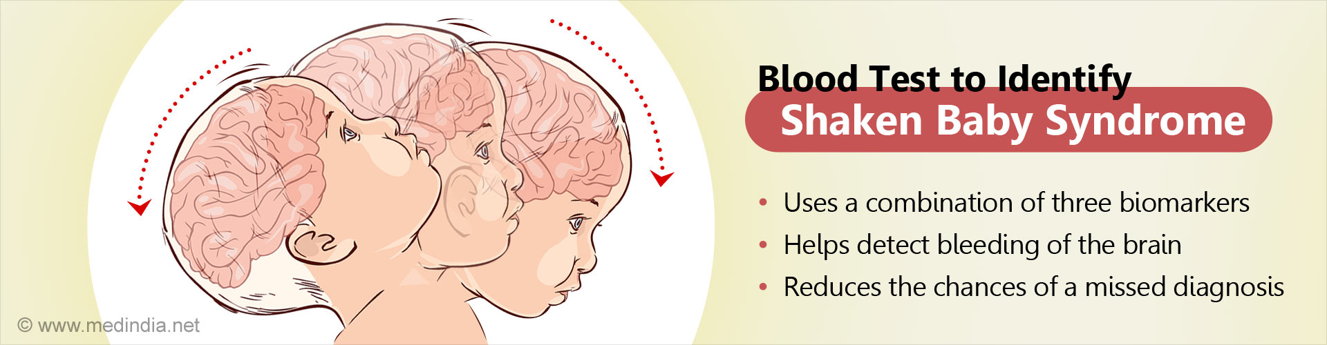 Blood Test to Identify Shaken Baby Syndrome
- Uses a combination of three biomarkers
- Helps detect bleeding of the brain
- Reduces the chances of a missed diagnosis